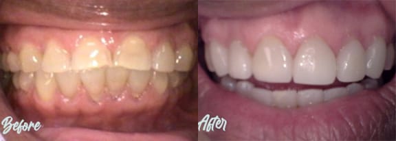 Before and after — an actual Tomlinson Dental patient