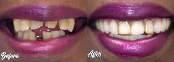 Before and after — an actual Tomlinson Dental patient