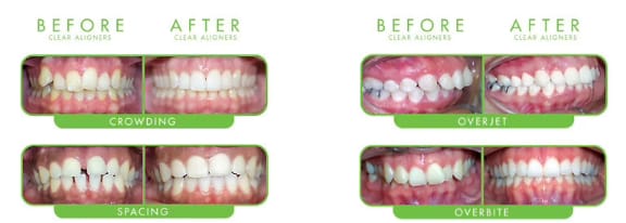 Before-and-after comparison of teeth straightened with ClearCorrect clear aligners at Tomlinson Dental, Tampa