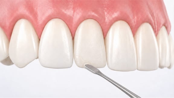 Dental bonding used to repair a chipped tooth
