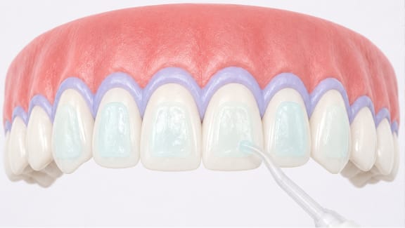 Illustration of teeth whitening