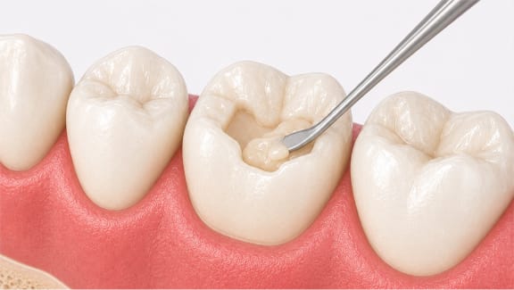 Tooth-colored filling placed in a molar