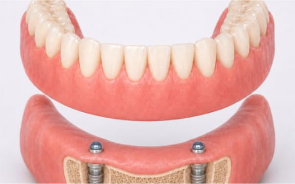 Before and after an implant-supported denture at Tomlinson Dental in Tampa
