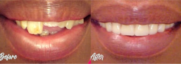 Before-and-after smile transformation