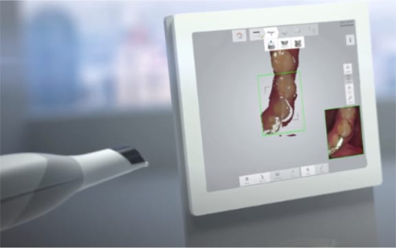 3Shape TRIOS intraoral scanner used at Tomlinson Dental